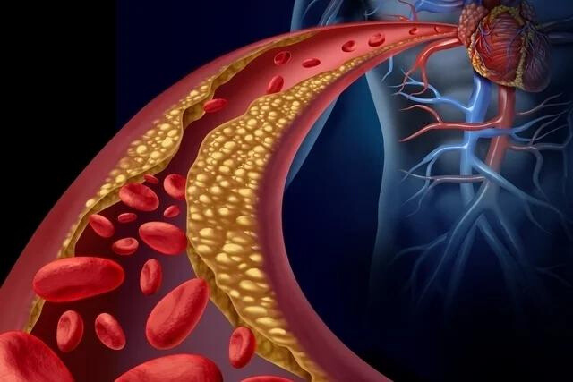 Arteria con Acumulación de Lípidos